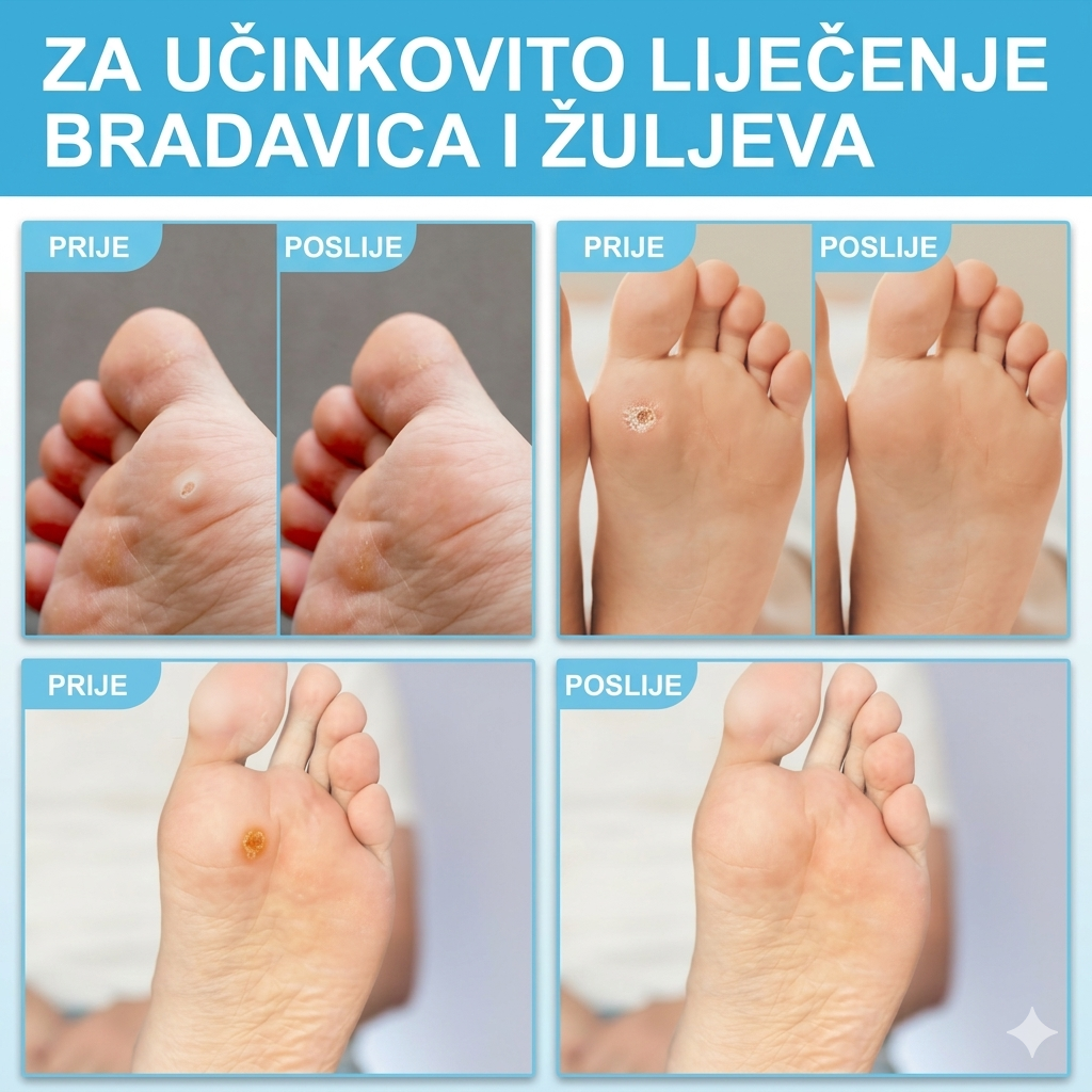 Flasteri za kurje oči - 24 komada